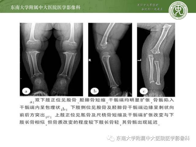 【病例】软骨发育不全1例X线影像表现
