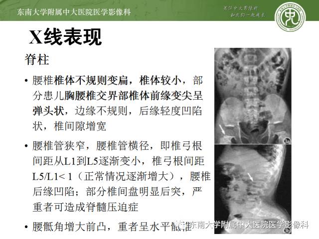 【病例】软骨发育不全1例X线影像表现