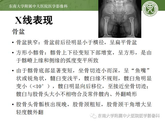 【病例】软骨发育不全1例X线影像表现
