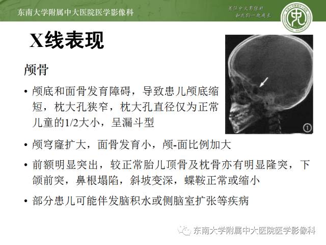 【病例】软骨发育不全1例X线影像表现