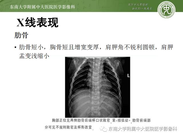 【病例】软骨发育不全1例X线影像表现