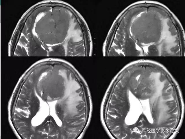 【病例】典型嗅沟脑膜瘤1例MR影像讨论