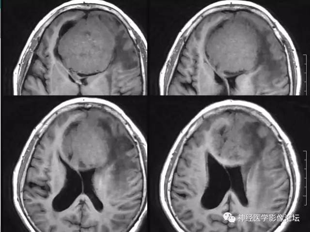 【病例】典型嗅沟脑膜瘤1例MR影像讨论