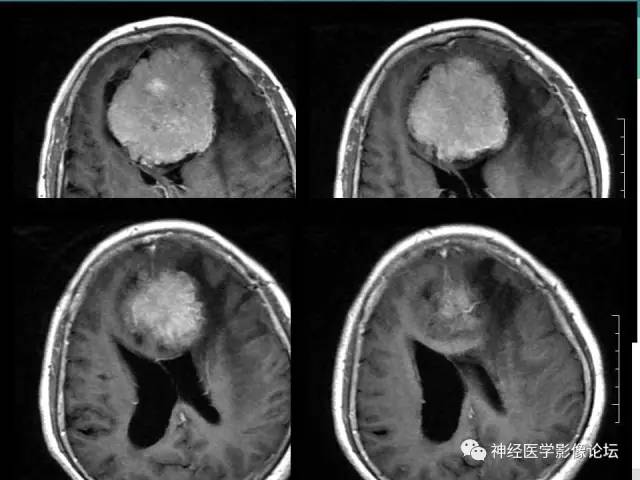 【病例】典型嗅沟脑膜瘤1例MR影像讨论