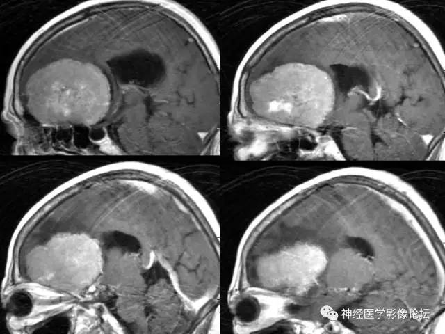 【病例】典型嗅沟脑膜瘤1例MR影像讨论