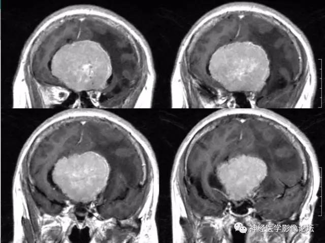【病例】典型嗅沟脑膜瘤1例MR影像讨论