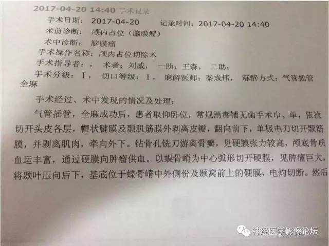 【病例】典型嗅沟脑膜瘤1例MR影像讨论
