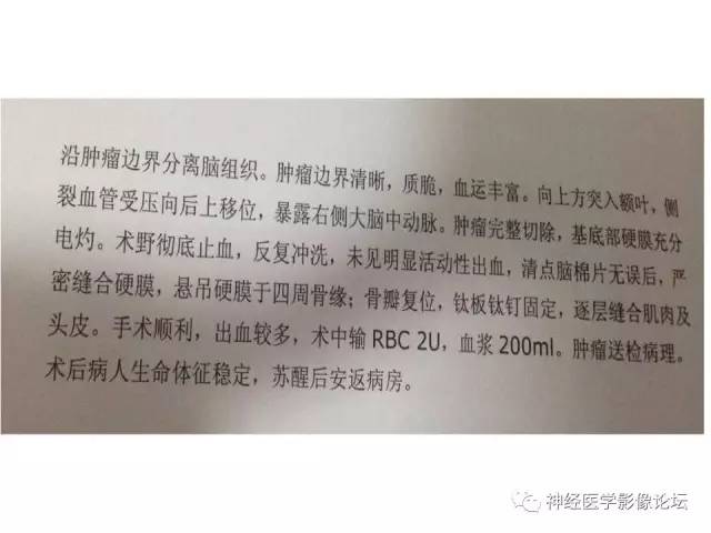 【病例】典型嗅沟脑膜瘤1例MR影像讨论