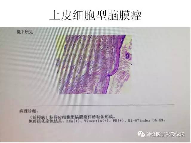【病例】典型嗅沟脑膜瘤1例MR影像讨论