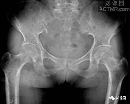 【病例】多发性骨髓瘤1例X线影像诊断分析 【病例】多发性骨髓瘤1例X线影像诊断分析
