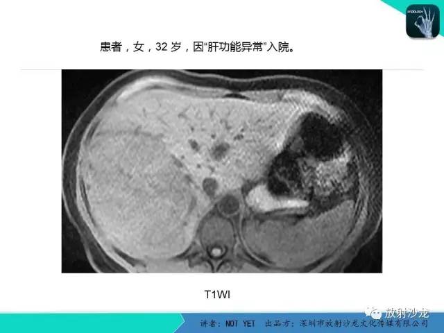 【病例】肝腺瘤1例CT影像表现