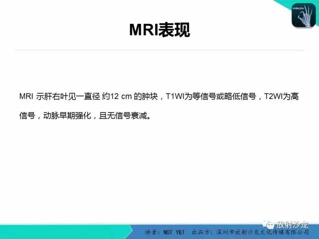【病例】肝腺瘤1例CT影像表现 【病例】肝腺瘤1例CT影像表现