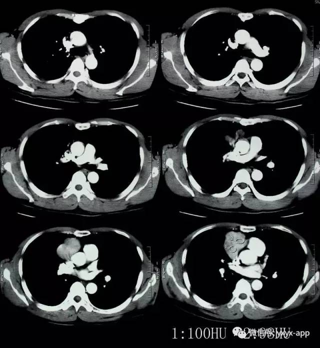 【病例】混合细胞型胸腺瘤1例CT影像表现
