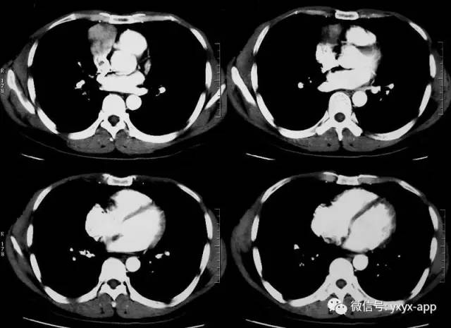 【病例】混合细胞型胸腺瘤1例CT影像表现 【病例】混合细胞型胸腺瘤1例CT影像表现
