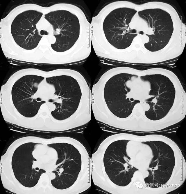 【病例】混合细胞型胸腺瘤1例CT影像表现 【病例】混合细胞型胸腺瘤1例CT影像表现
