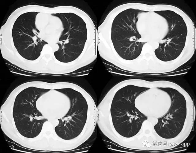 【病例】混合细胞型胸腺瘤1例CT影像表现 【病例】混合细胞型胸腺瘤1例CT影像表现