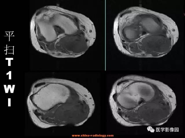 【病例】腘窝恶性纤维组织细胞瘤1例MR 【病例】腘窝恶性纤维组织细胞瘤1例MR