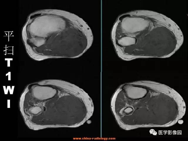【病例】腘窝恶性纤维组织细胞瘤1例MR