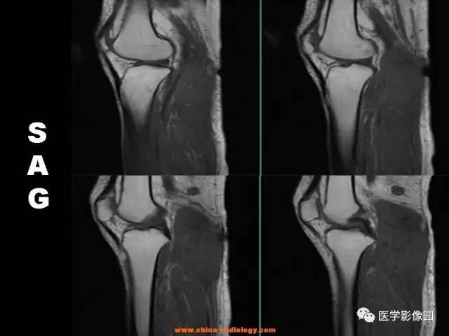 【病例】腘窝恶性纤维组织细胞瘤1例MR 【病例】腘窝恶性纤维组织细胞瘤1例MR