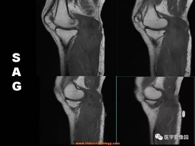 【病例】腘窝恶性纤维组织细胞瘤1例MR 【病例】腘窝恶性纤维组织细胞瘤1例MR
