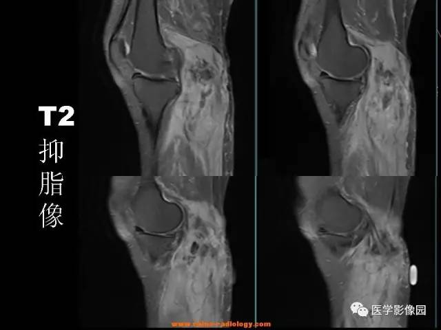 【病例】腘窝恶性纤维组织细胞瘤1例MR 【病例】腘窝恶性纤维组织细胞瘤1例MR