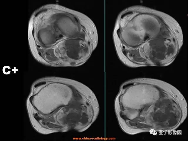 【病例】腘窝恶性纤维组织细胞瘤1例MR 【病例】腘窝恶性纤维组织细胞瘤1例MR