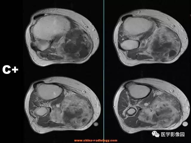 【病例】腘窝恶性纤维组织细胞瘤1例MR 【病例】腘窝恶性纤维组织细胞瘤1例MR