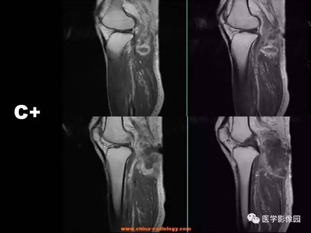 【病例】腘窝恶性纤维组织细胞瘤1例MR 【病例】腘窝恶性纤维组织细胞瘤1例MR