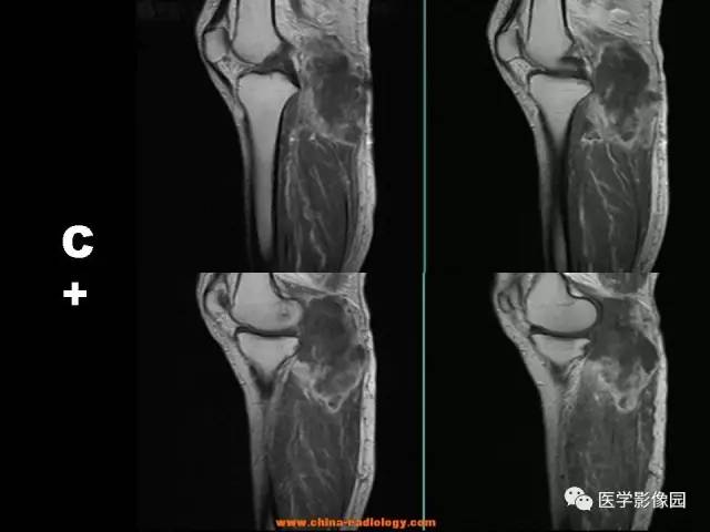 【病例】腘窝恶性纤维组织细胞瘤1例MR 【病例】腘窝恶性纤维组织细胞瘤1例MR