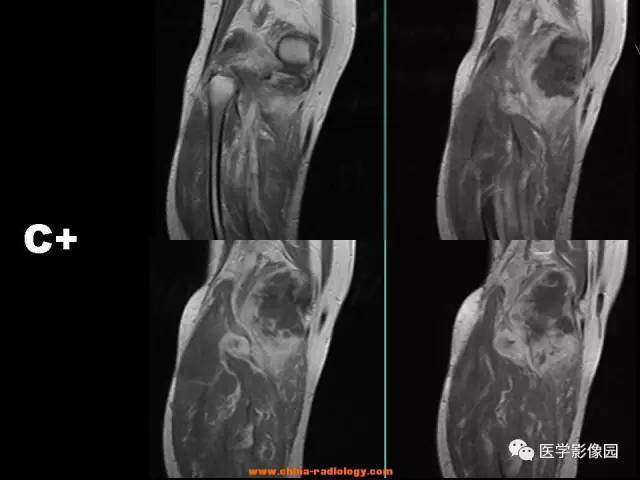 【病例】腘窝恶性纤维组织细胞瘤1例MR 【病例】腘窝恶性纤维组织细胞瘤1例MR