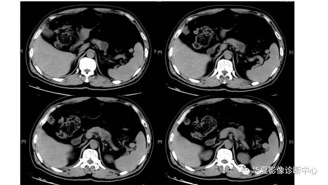 【病例】慢性胰腺炎伴潴留囊肿1例CT