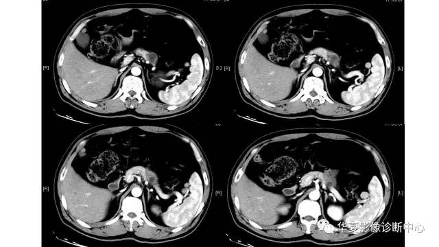 【病例】慢性胰腺炎伴潴留囊肿1例CT