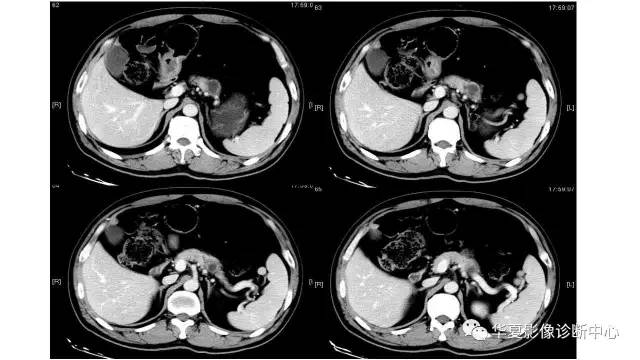 【病例】慢性胰腺炎伴潴留囊肿1例CT