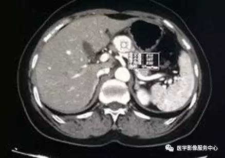 【病例】胰颈神经内分泌肿瘤1例CT影像表现