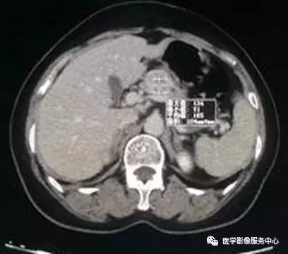 【病例】胰颈神经内分泌肿瘤1例CT影像表现 【病例】胰颈神经内分泌肿瘤1例CT影像表现