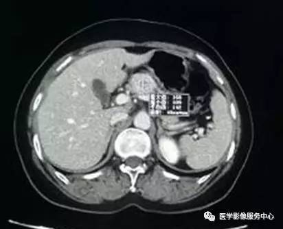 【病例】胰颈神经内分泌肿瘤1例CT影像表现 【病例】胰颈神经内分泌肿瘤1例CT影像表现