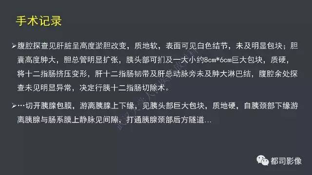 【病例】小肠肠病型T细胞淋巴瘤1例CT影像诊断