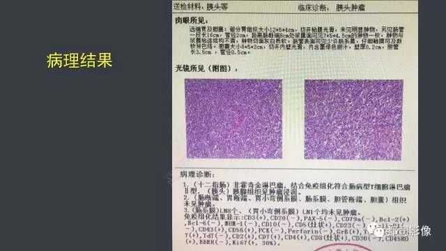 【病例】小肠肠病型T细胞淋巴瘤1例CT影像诊断