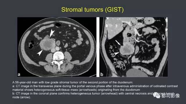 【病例】小肠肠病型T细胞淋巴瘤1例CT影像诊断