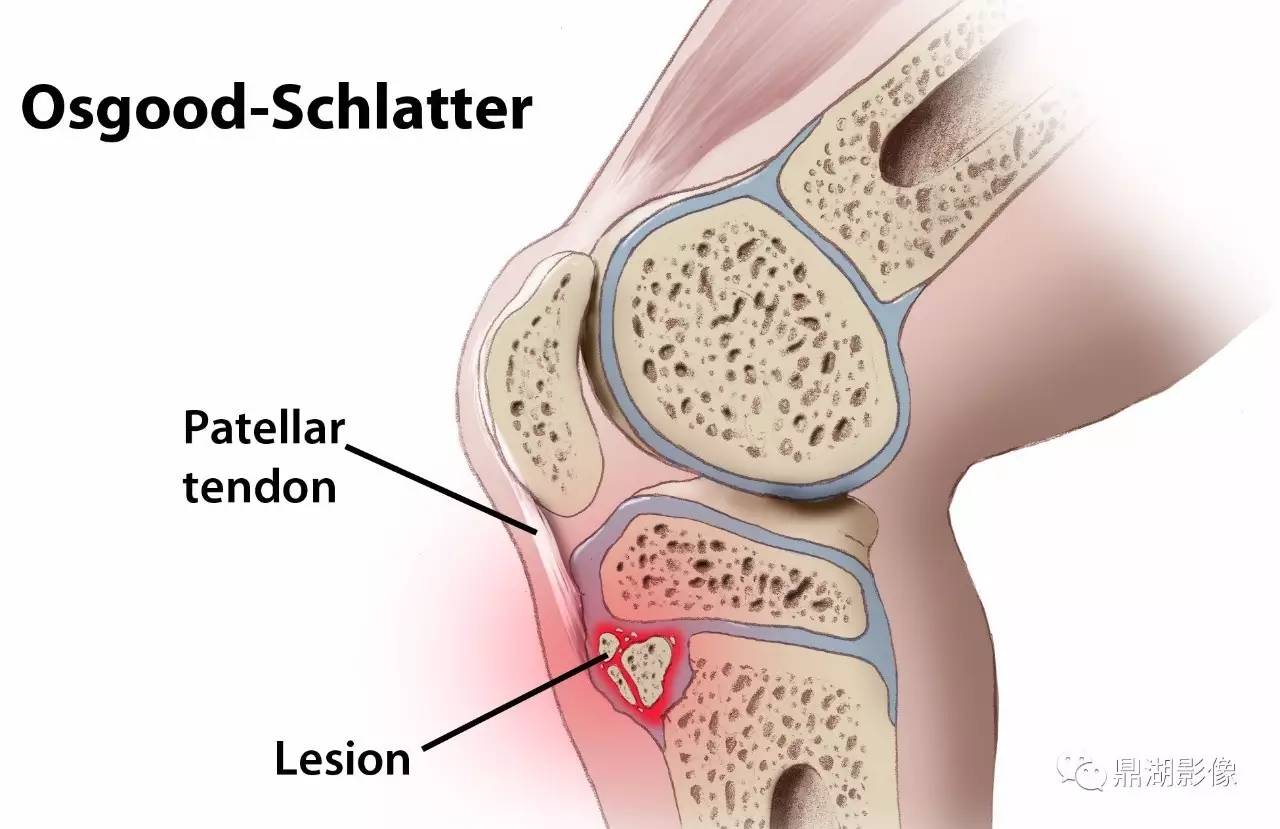 胫骨结节骨骺炎Osgood-Schlatter disease 胫骨结节骨骺炎Osgood-Schlatter disease