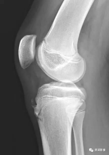 胫骨结节骨骺炎Osgood-Schlatter disease 胫骨结节骨骺炎Osgood-Schlatter disease
