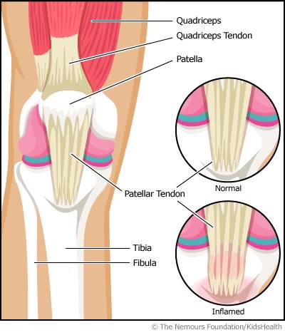 胫骨结节骨骺炎Osgood-Schlatter disease 胫骨结节骨骺炎Osgood-Schlatter disease
