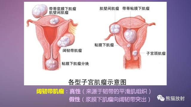 【PPT】女性盆腔肿瘤的MRI诊断