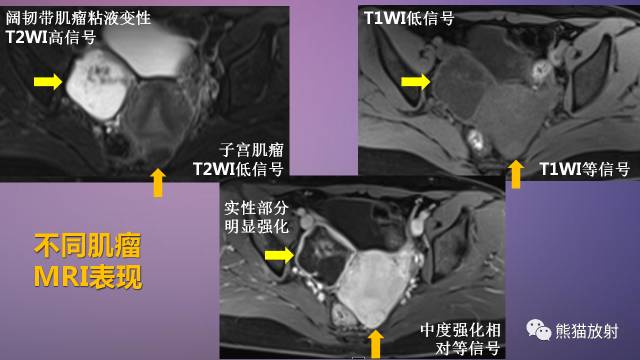 【PPT】女性盆腔肿瘤的MRI诊断