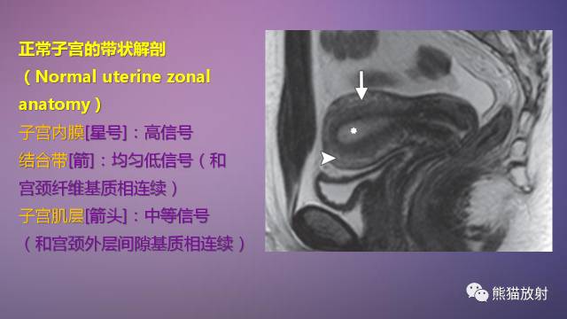 【PPT】女性盆腔肿瘤的MRI诊断