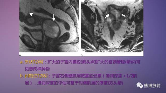 【PPT】女性盆腔肿瘤的MRI诊断