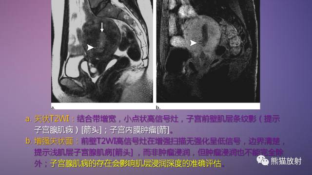 【PPT】女性盆腔肿瘤的MRI诊断