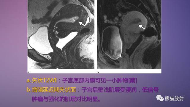 【PPT】女性盆腔肿瘤的MRI诊断