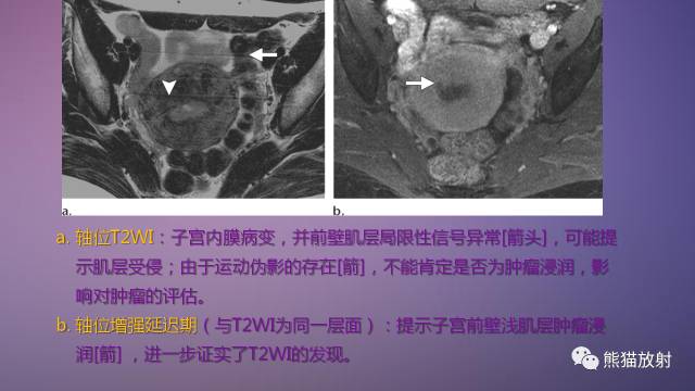 【PPT】女性盆腔肿瘤的MRI诊断
