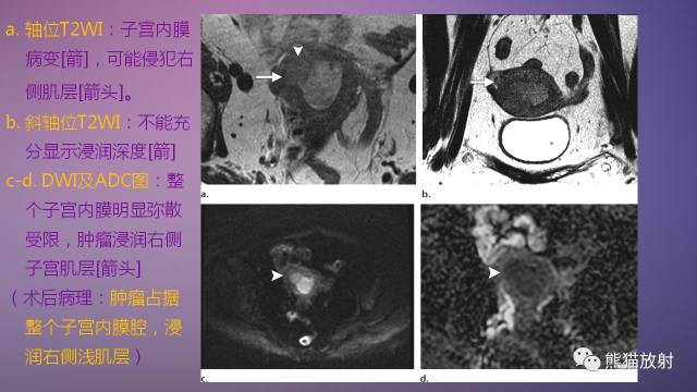 【PPT】女性盆腔肿瘤的MRI诊断